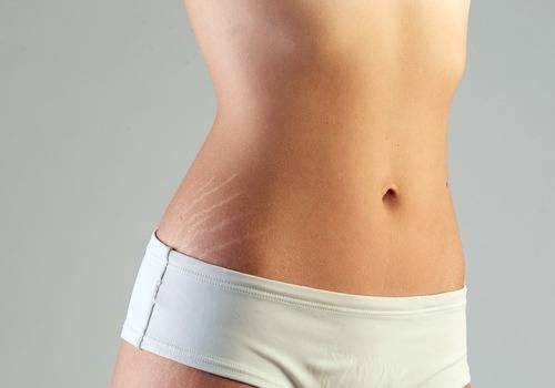 stretch marks