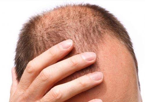 man losing hair